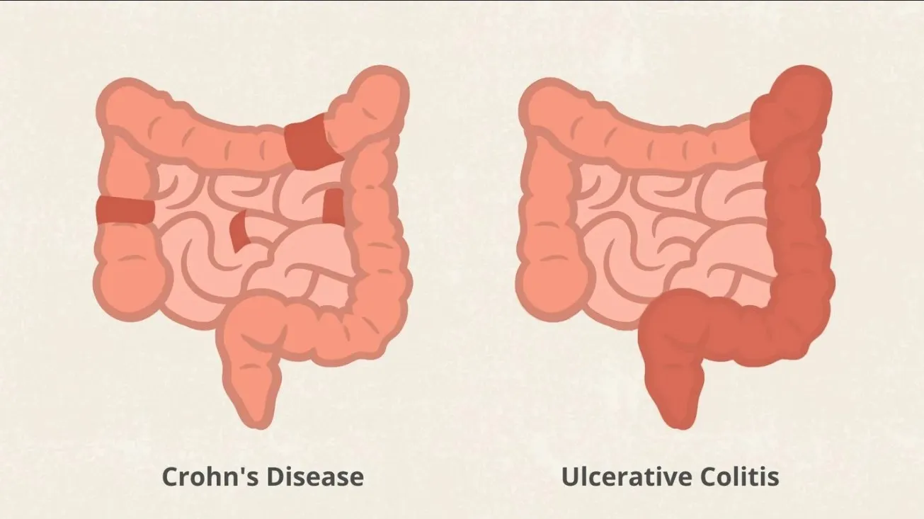 Crohn Hastalığı Nedir Crohn Hastalığı Belirtileri ve Tedavisi - Özel Pendik Şifa Tıp Merkezi