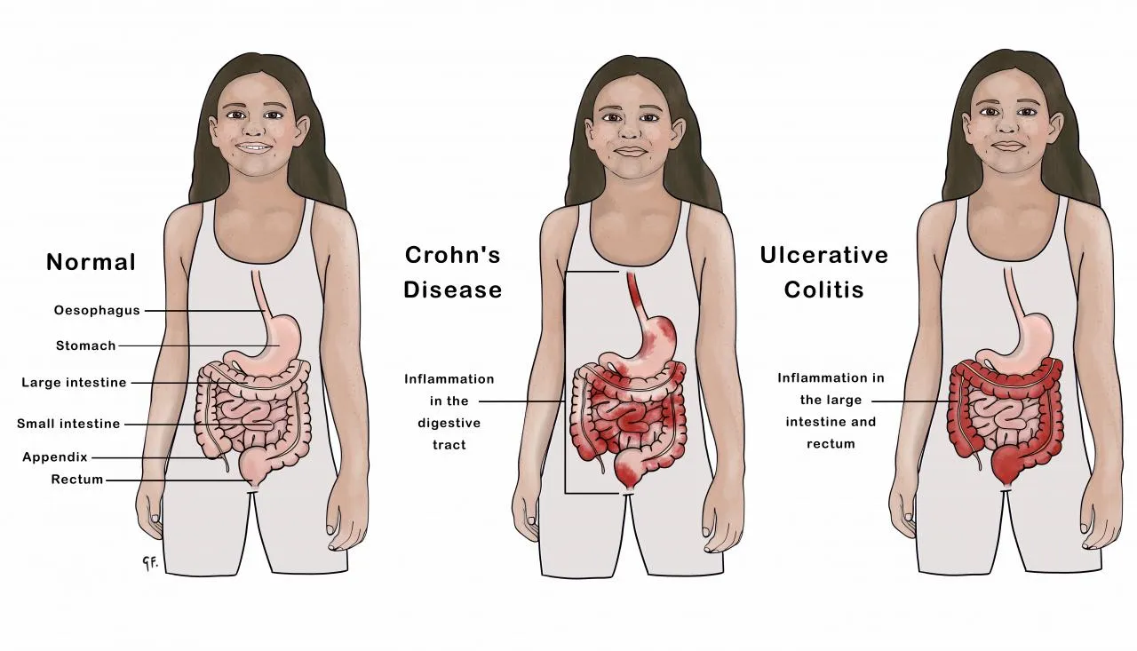 Crohn Hastalığı Nedir Crohn Hastalığı Belirtileri ve Tedavisi - Özel Pendik Şifa Tıp Merkezi