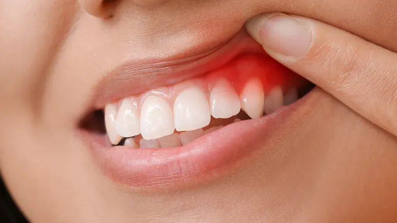 Gingivitis Nedir ve Nasıl Önlenebilir - Özel Pendik Şifa Tıp Merkezi
