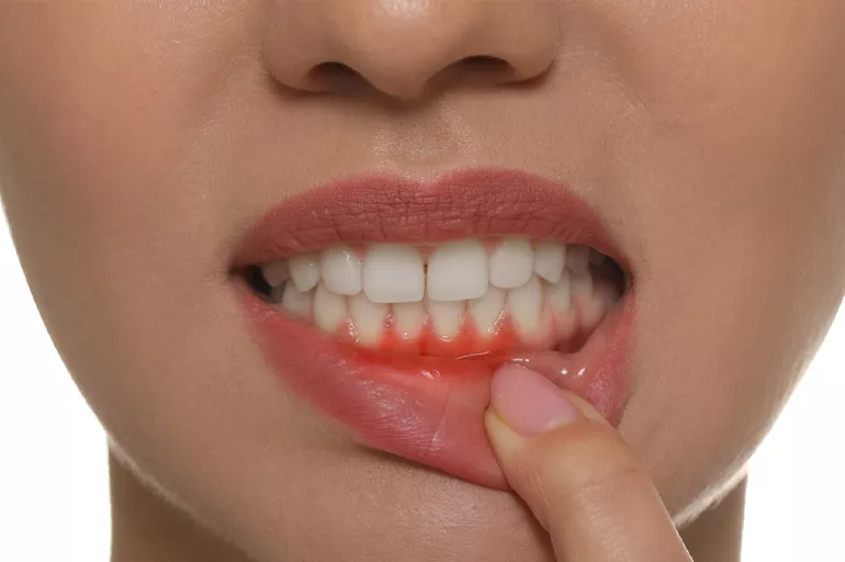 Gingivitis Nedir ve Nasıl Önlenebilir - Özel Pendik Şifa Tıp Merkezi
